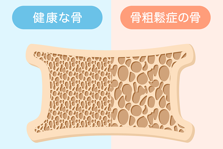 骨粗鬆症のイメージ画像
